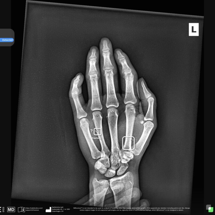 Lunit RB Fracture